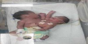 اخبار اليمن | سقطرى تشهد أول ولادة نادرة لتوأم ”سيامي”