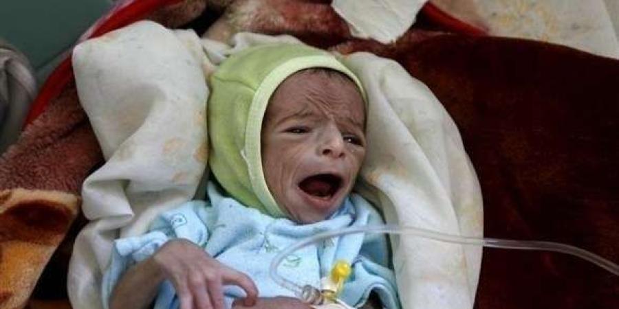 46 % من أطفال اليمن يعانون التقزم