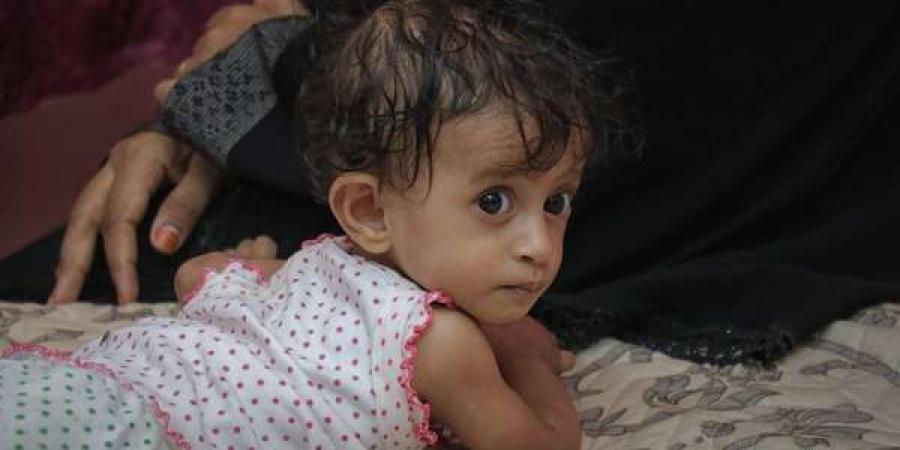 الصحة العالمية تعلن علاج 2255 طفلًا مصابًا بسوء التغذية في اليمن