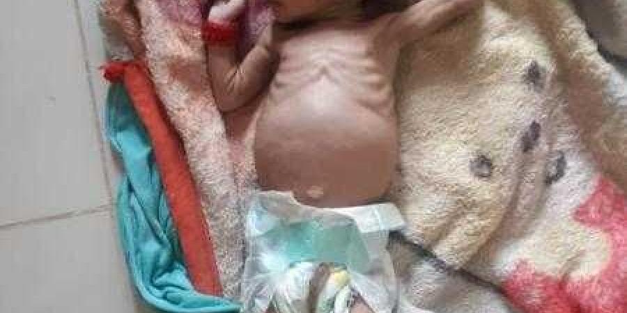 اخبار اليمن | شاهد .. صورة طفل مسربة من أحد المستشفيات في ذمار تثير غضب اليمنيين