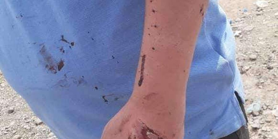 اخبار اليمن | شاهد الصور الأولى للاعتداء الوحشي على الكبسي
