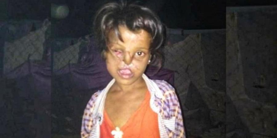 اخبار اليمن | طفلة مشوهة الوجه بحاجة لعملية تجميلية.. تنتظر من يعيد لها البسمة!