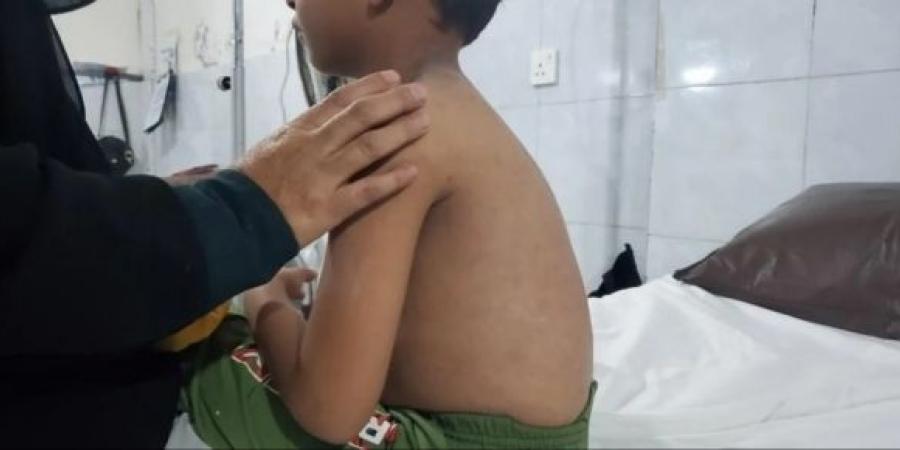 اخبار اليمن | اليمن: أكثر من 1500 إصابة بالحصبة بين الأطفال في مناطق الحوثيين بتعز خلال السبعة الأشهر الأخيرة
